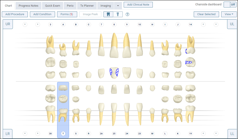 Charting Supernumerary Teeth Dentrix Ascend