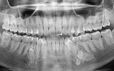 Charting Supernumerary Teeth