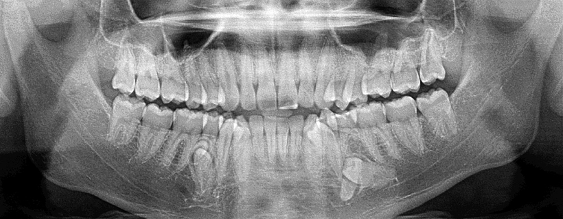 Charting Supernumerary Teeth
