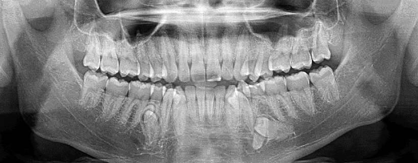 Supernumerary Teeth Chart